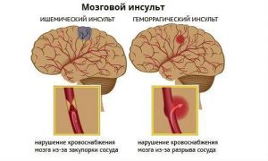 Заболевания сосудов головного мозга